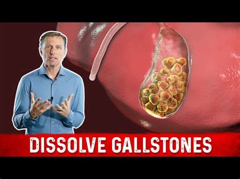 • May <b>dissolve</b> <b>gallstones</b> before they are completely formed* •. . Does tudca dissolve gallstones